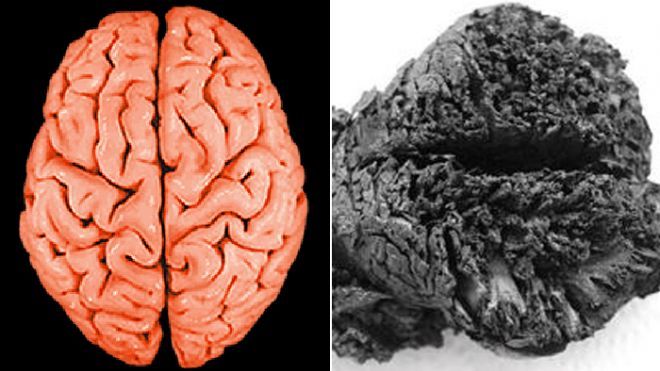 土耳其发现世界最古老人脑 已有4000年历史